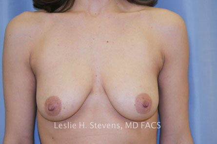 Breast Augmentation Before and After | Dr. Leslie Stevens