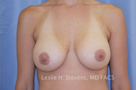 Breast Augmentation Before and After 44