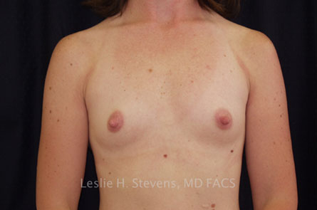 Breast Augmentation Before and After 36