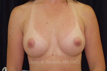 Breast Augmentation Before and After 50