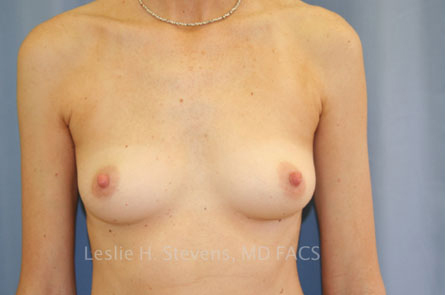 Breast Augmentation Before and After 38