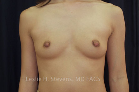 Breast Augmentation Before and After | Dr. Leslie Stevens