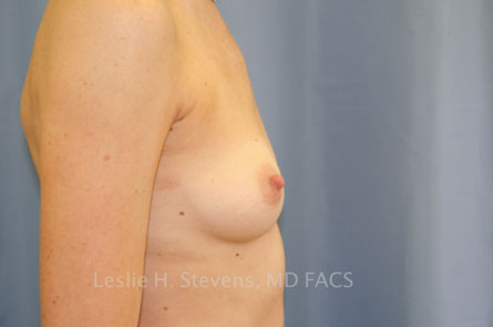 Breast Augmentation Before and After 39