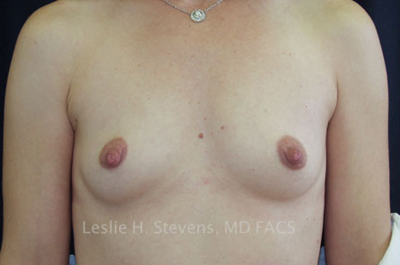 Breast Augmentation Before and After 40