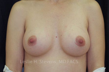 Breast Augmentation Before and After 47
