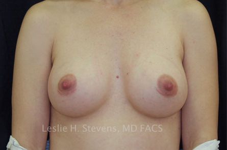 Breast Augmentation Before and After 54