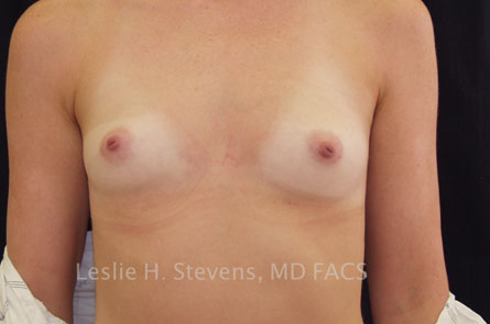 Breast Augmentation Before and After | Dr. Leslie Stevens