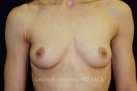 Breast Augmentation Before and After | Dr. Leslie Stevens