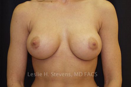 Breast Augmentation Before and After 50