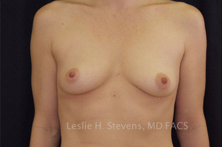 Breast Augmentation Before and After | Dr. Leslie Stevens