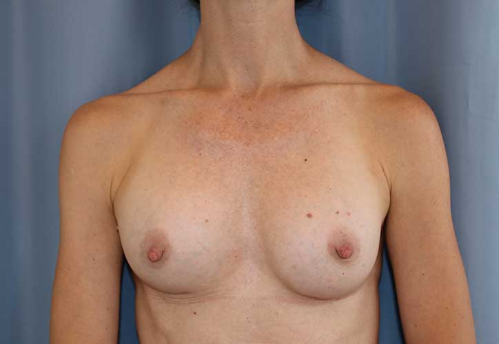 Breast Augmentation Before and After 54