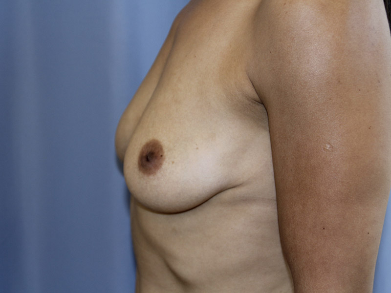 Breast Augmentation Before and After 49