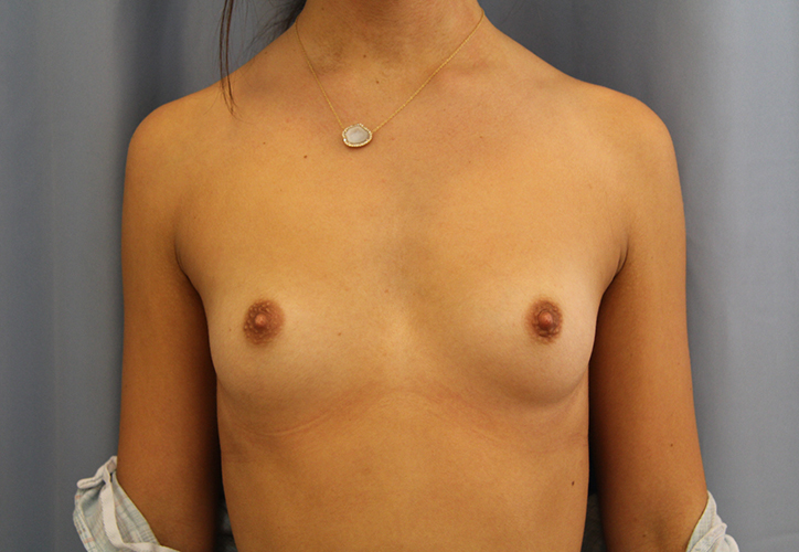 Breast Augmentation Before and After | Dr. Leslie Stevens