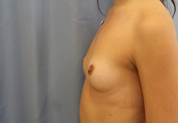 Breast Augmentation Before and After 51