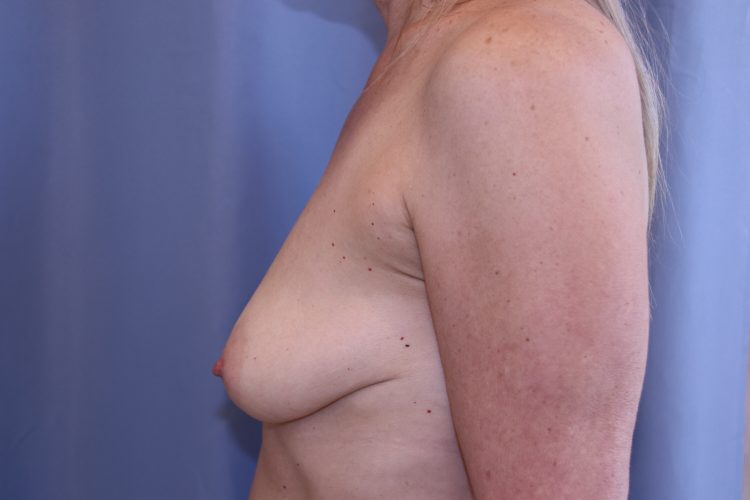 Breast Lift With Augmentation Before and After 04