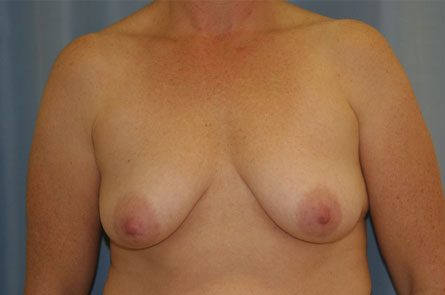 Breast Lift With Augmentation Before and After | Dr. Leslie Stevens