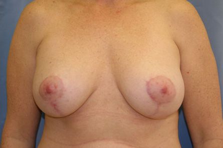 Breast Lift With Augmentation Before and After 11