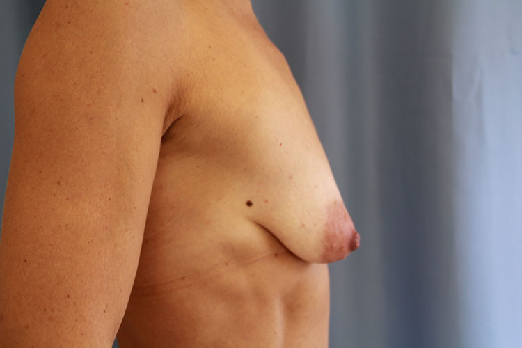 Breast Lift With Augmentation Before and After 06