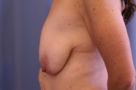 Breast Lift With Augmentation Before and After 09