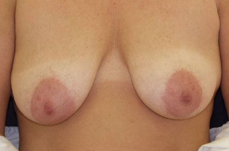 Breast Lift With Augmentation Before and After 11