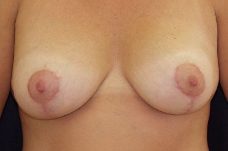 Breast Lift With Augmentation Before and After | Dr. Leslie Stevens