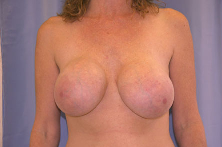 Breast Lift With Augmentation Before and After 12