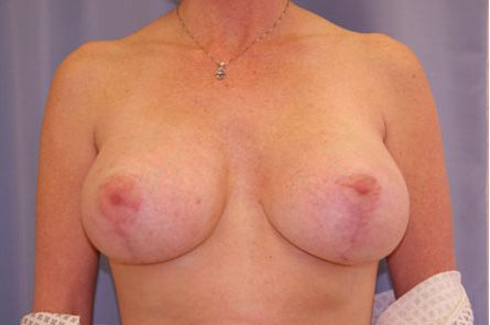 Breast Lift With Augmentation Before and After | Dr. Leslie Stevens