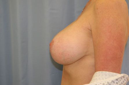 Breast Lift With Augmentation Before and After 12