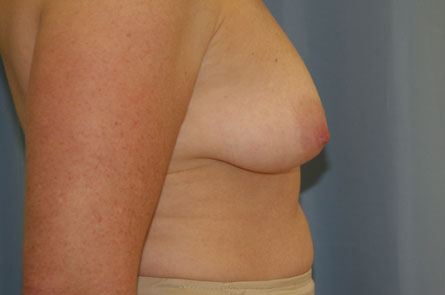 Breast Lift With Augmentation Before and After 13