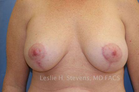 Breast Lift With Augmentation Before and After | Dr. Leslie Stevens