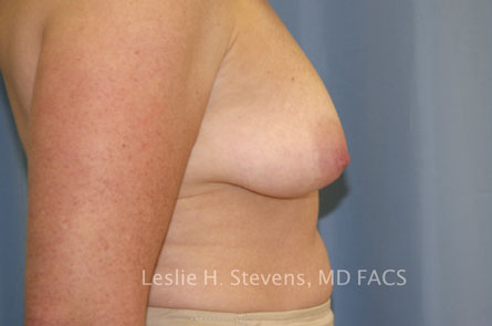 Breast Lift With Augmentation Before and After 14