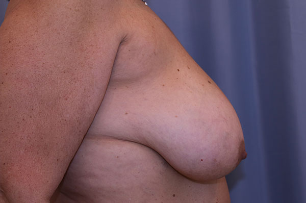 Breast Lift Before and After 01