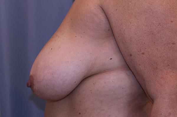 Breast Lift Before and After 01