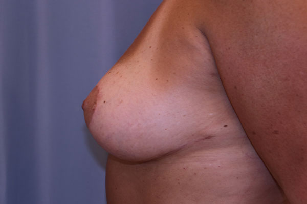 Breast Lift Before and After 01