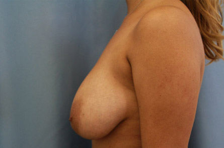 Breast Lift Before and After 02