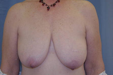 Breast Lift Before and After | Dr. Leslie Stevens