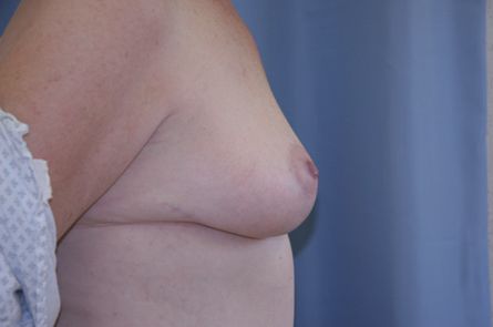 Breast Lift Before and After 04