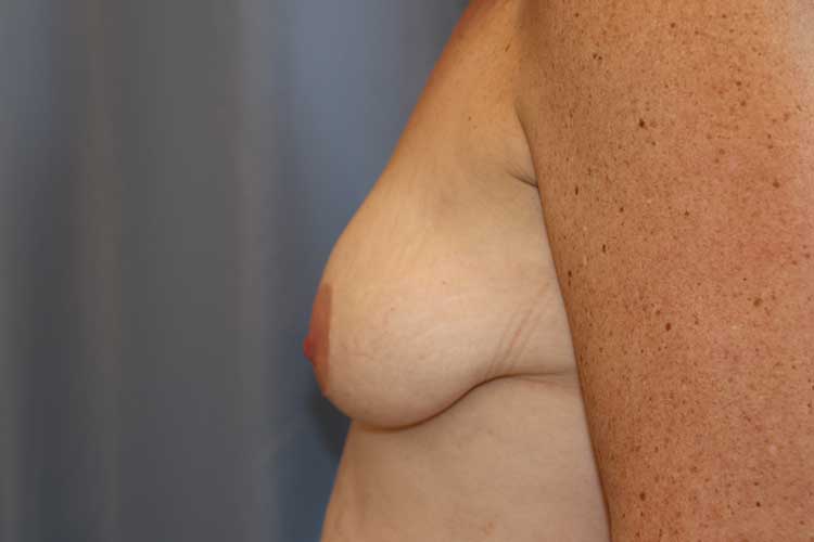 Breast Lift Before and After 05