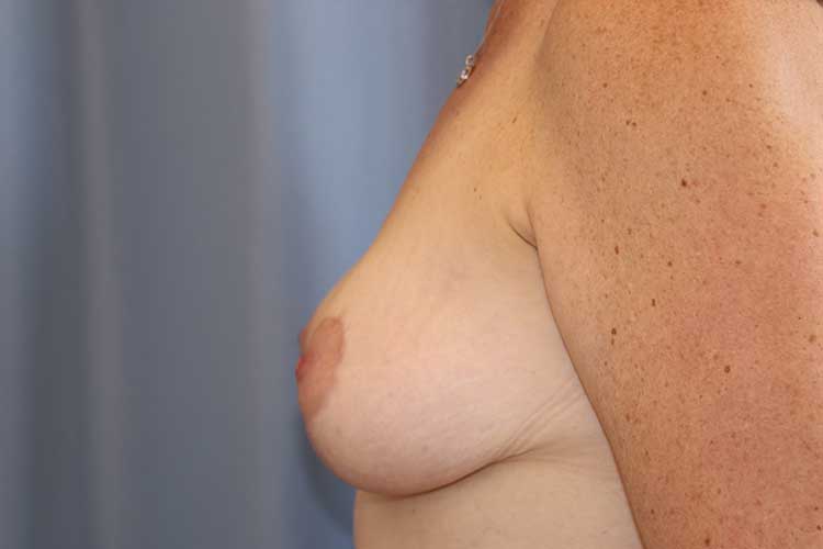 Breast Lift Before and After 05