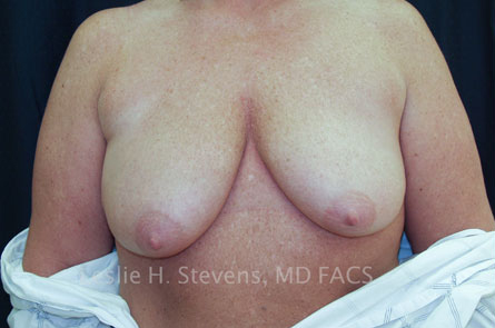 Breast Lift Before and After 06