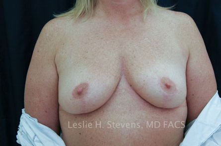 Breast Lift Before and After | Dr. Leslie Stevens
