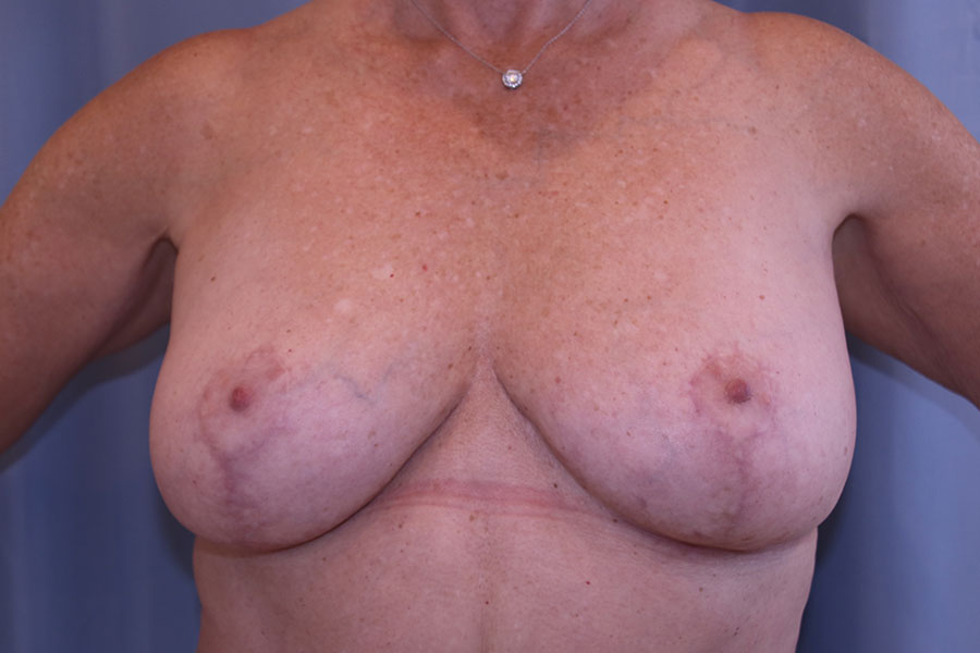 Breast Reduction Before and After 03