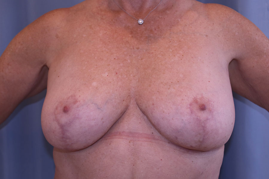 Breast Reduction Before and After 09