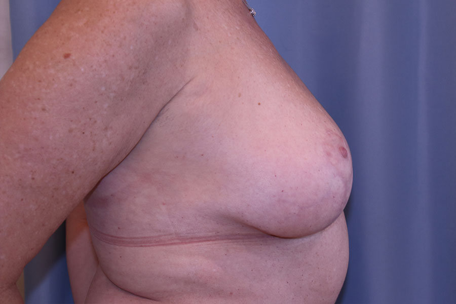 Breast Reduction Before and After 02