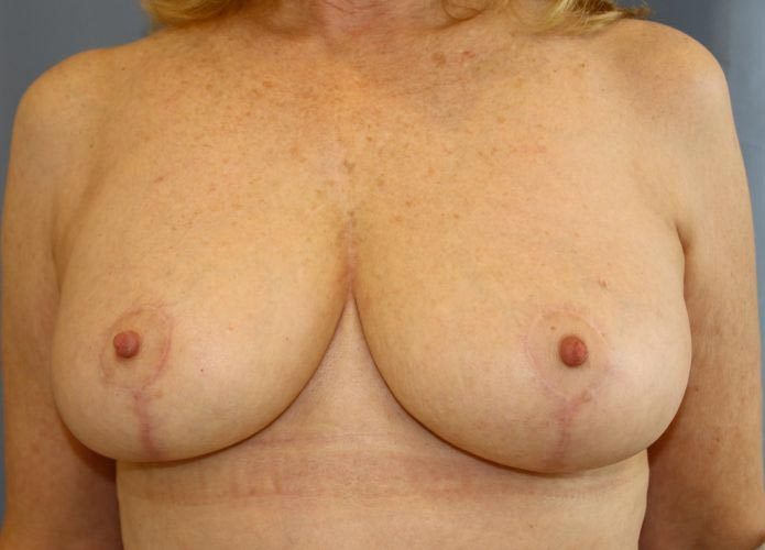 Breast Reduction Before and After 11