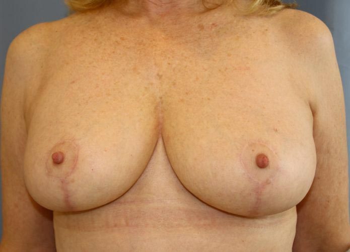 Breast Reduction Before and After 13