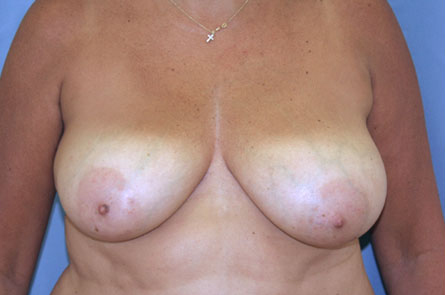 Breast Reduction Before and After 05