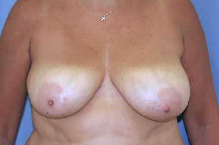 Breast Reduction Before and After | Dr. Leslie Stevens