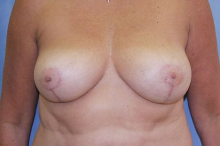 Breast Reduction Before and After 14