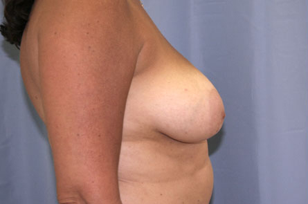 Breast Reduction Before and After 05